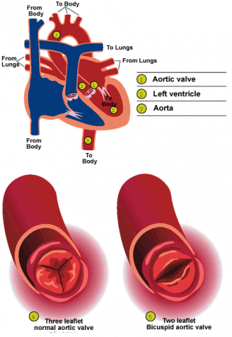 Aortic Valve Leaflets