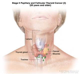 Thyroid Cancer Treatment (Adult) (PDQ®): Treatment - Health ...