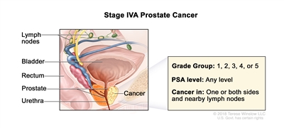 Prostate Cancer Treatment Pdq Treatment Patient Information Nci Cs Mott Children S Hospital Michigan Medicine