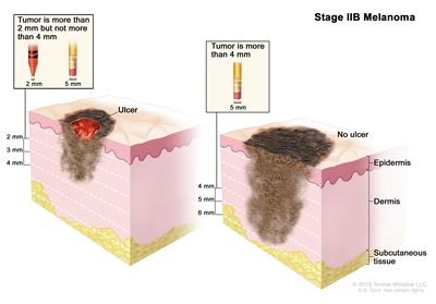 Melanoma Treatment (PDQ®): Treatment - Health Professional Information