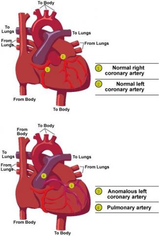 Anomalous Left Coronary Artery | CS Mott Children's Hospital | Michigan ...