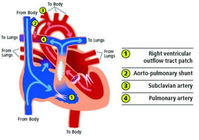 Pulmonary Atresia | CS Mott Children's Hospital: University of Michigan ...